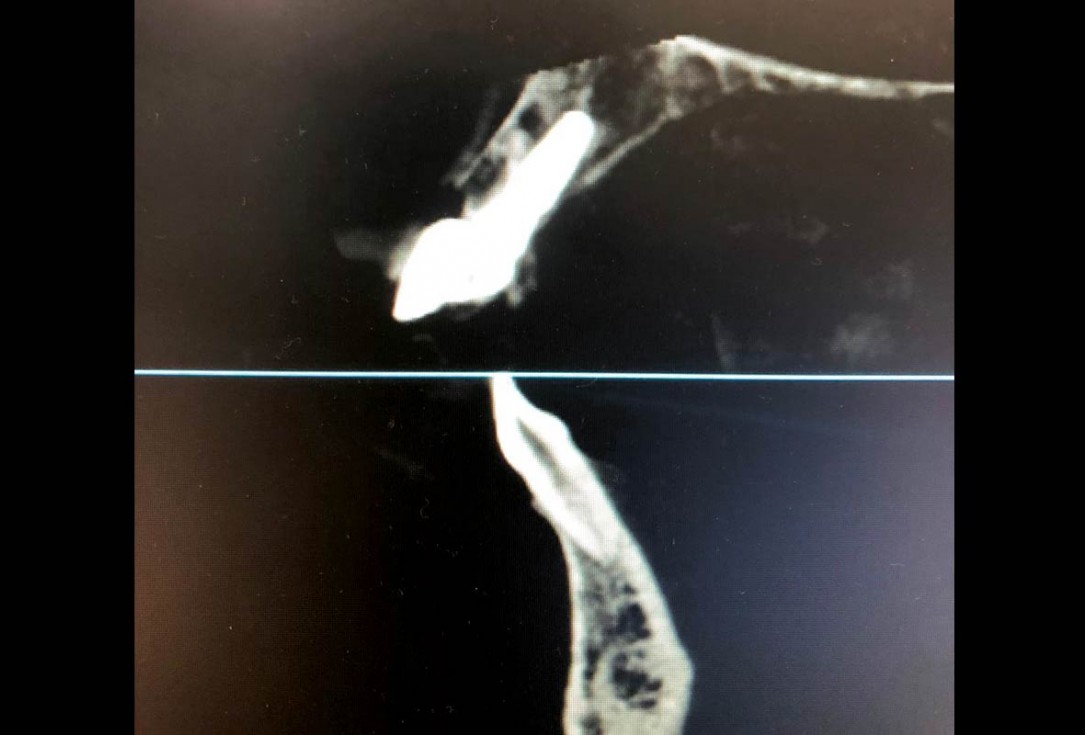 cerabone® and mucoderm® for immediate implantation in the aesthetic area - Dr. D. Robles 