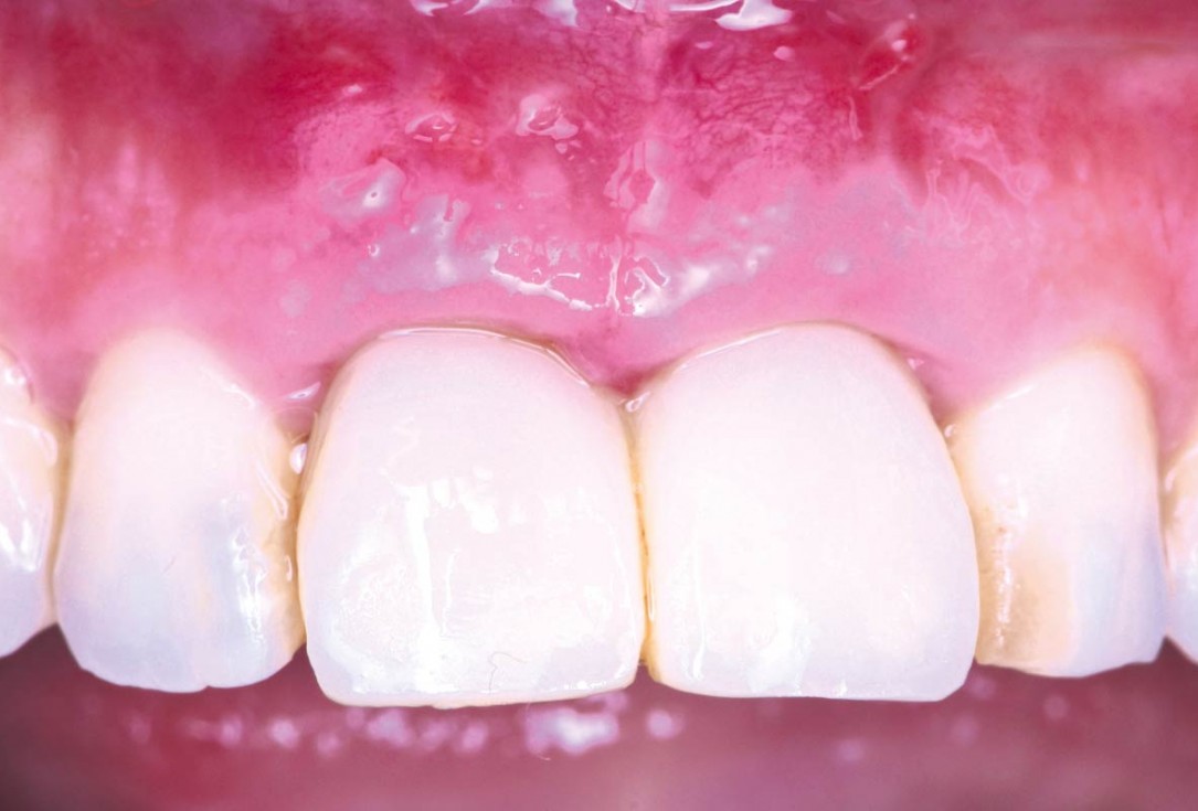 cerabone® and mucoderm® for immediate implantation in the aesthetic area - Dr. D. Robles 