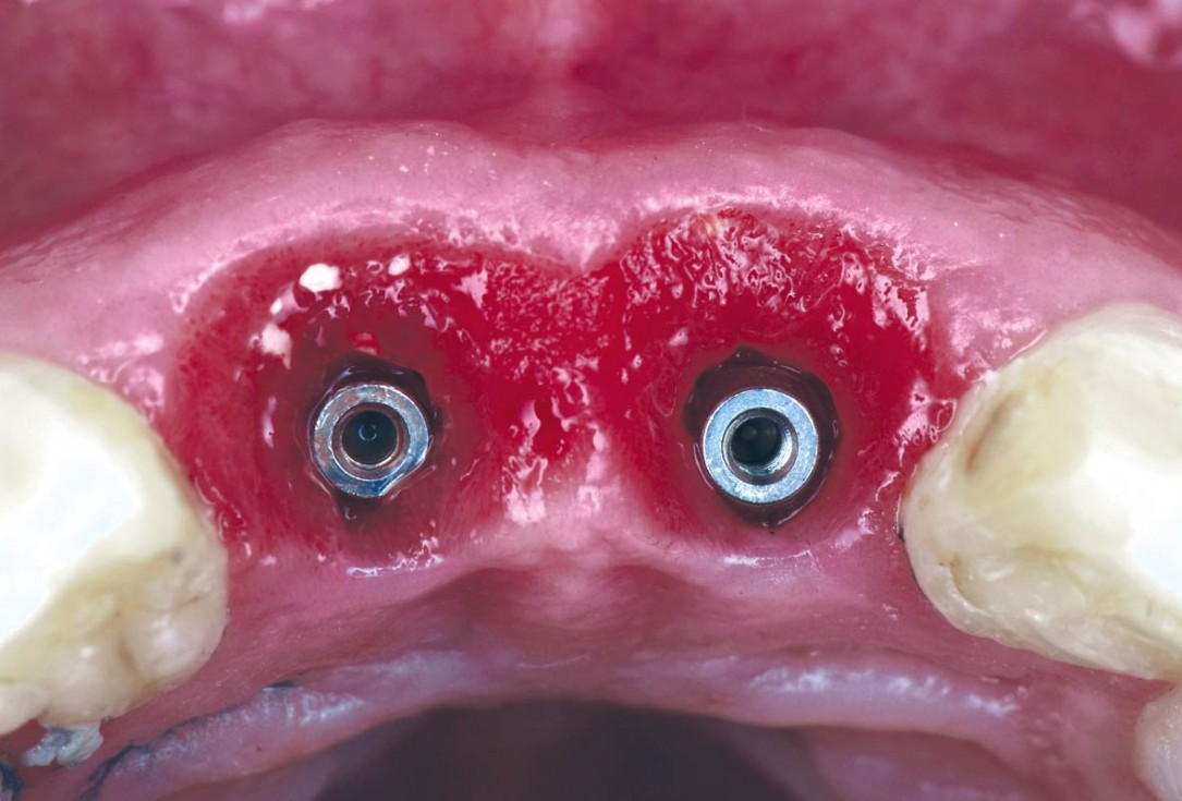 cerabone® and mucoderm® for immediate implantation in the aesthetic area - Dr. D. Robles 