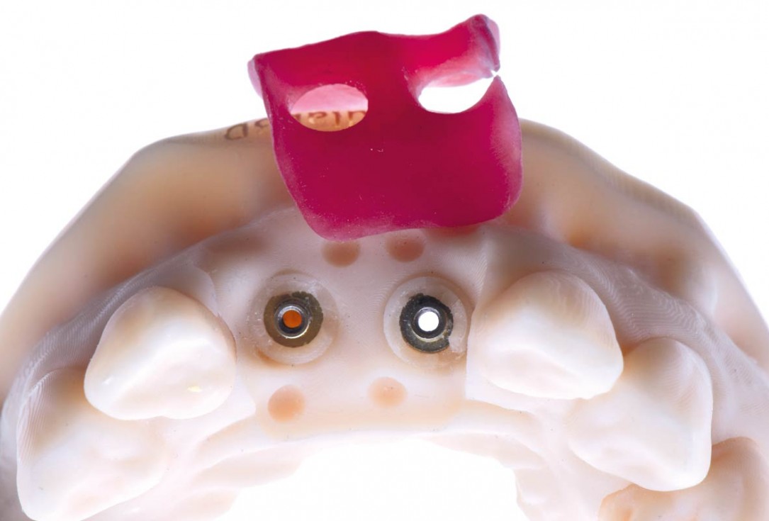 cerabone® and mucoderm® for immediate implantation in the aesthetic area - Dr. D. Robles 