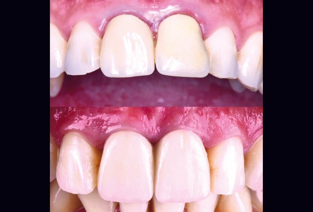 cerabone® and mucoderm® for immediate implantation in the aesthetic area - Dr. D. Robles 