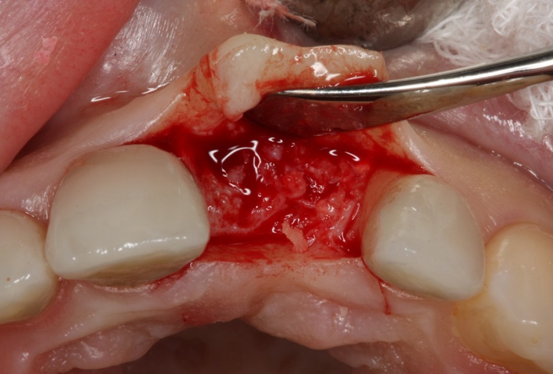 Socket preservation with mucoderm® & maxgraft® - Dr. A. Puisys