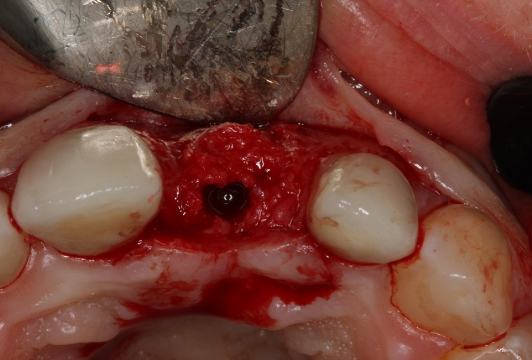 Socket preservation with mucoderm® & maxgraft® - Dr. A. Puisys