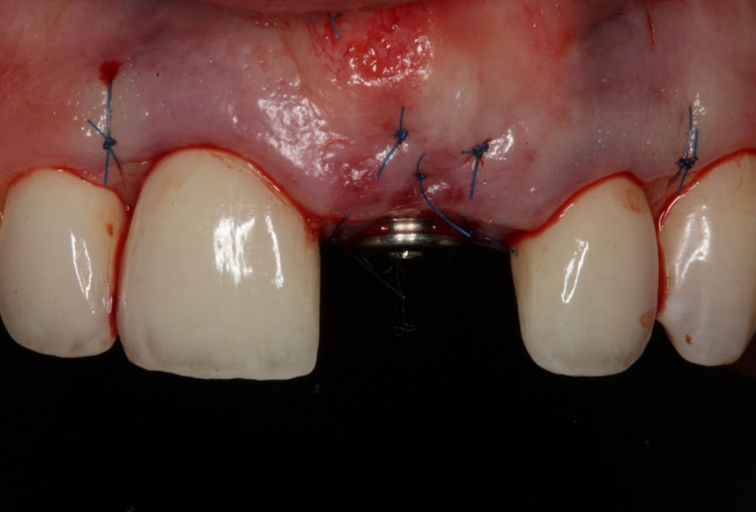 Socket preservation with mucoderm® & maxgraft® - Dr. A. Puisys