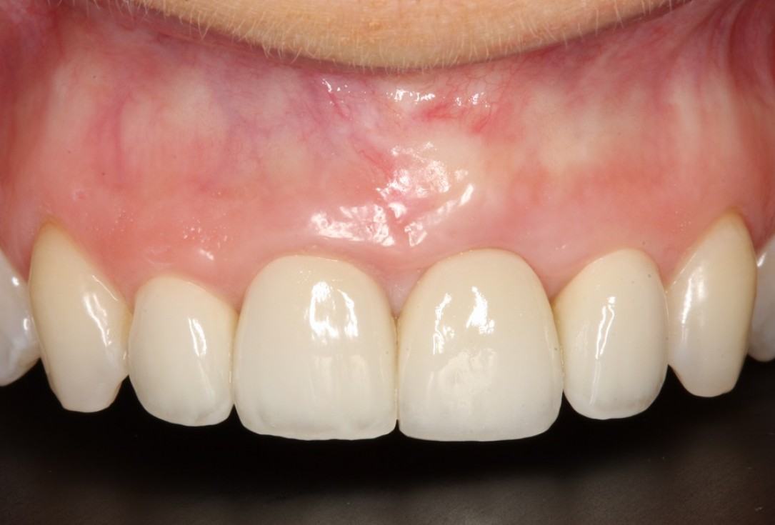 Socket preservation with mucoderm® & maxgraft® - Dr. A. Puisys