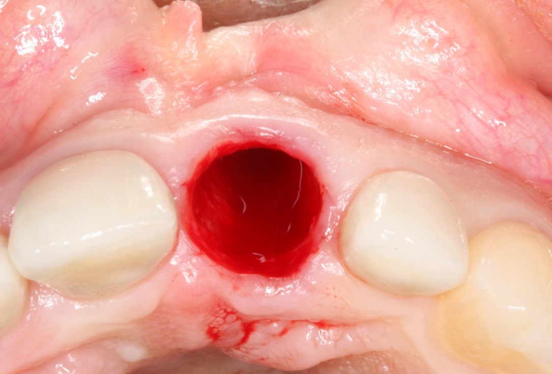 Socket preservation with mucoderm® & maxgraft® - Dr. A. Puisys