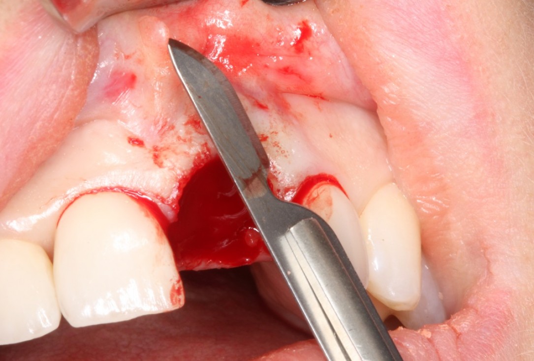 Socket preservation with mucoderm® & maxgraft® - Dr. A. Puisys