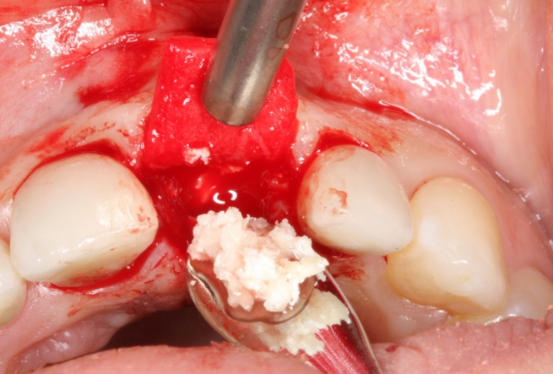 Socket preservation with mucoderm® & maxgraft® - Dr. A. Puisys