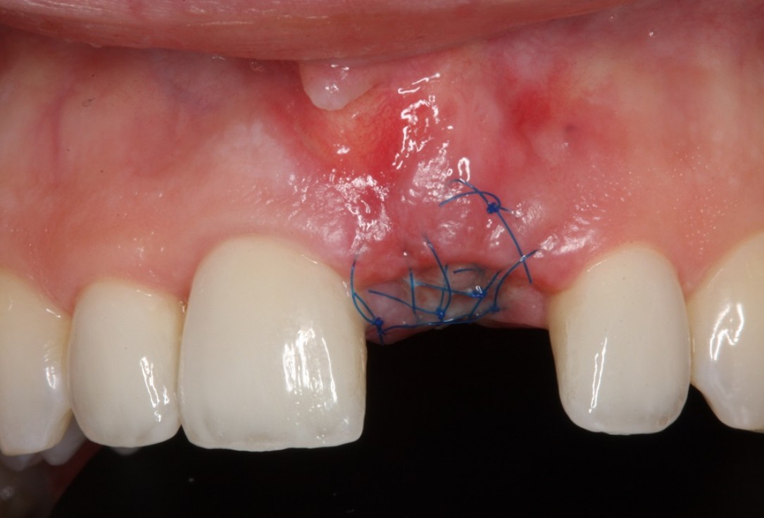 Socket preservation with mucoderm® & maxgraft® - Dr. A. Puisys