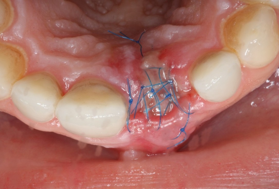 Socket preservation with mucoderm® & maxgraft® - Dr. A. Puisys