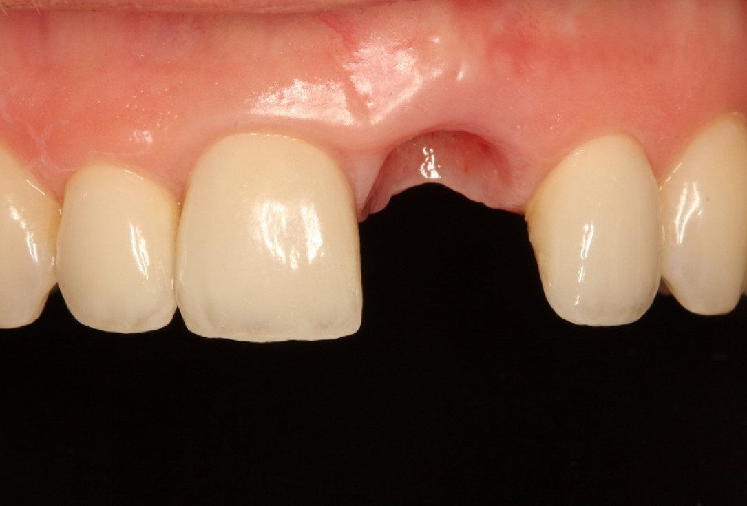 Socket preservation with mucoderm® & maxgraft® - Dr. A. Puisys