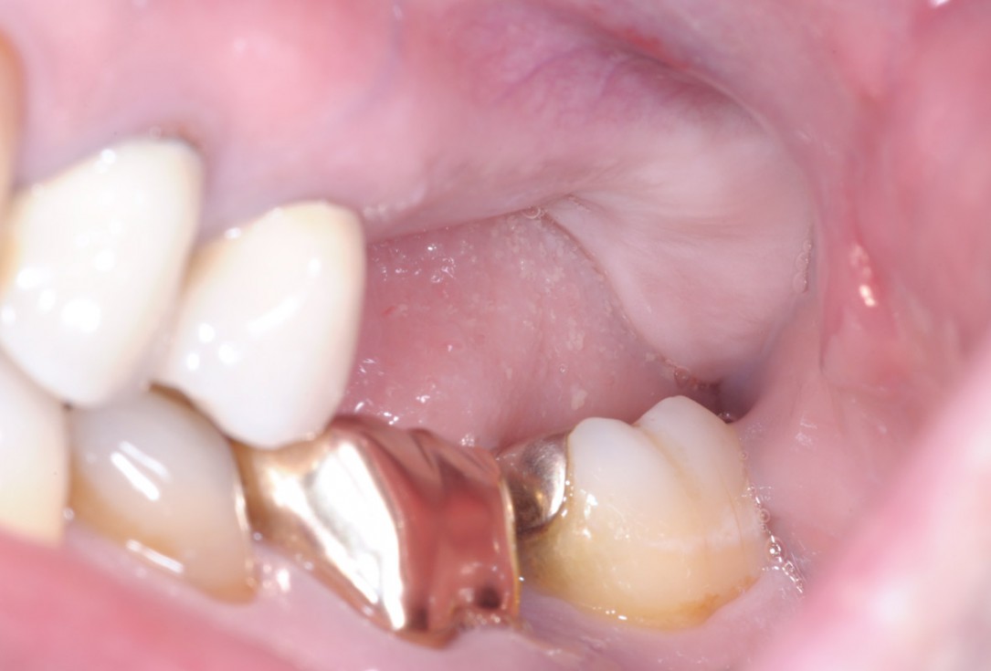 Treatment of a combined horizontal and vertical bone defect in the maxilla with maxgraft® cortico in the allogenic shell technique - Dr. R. Würdinger