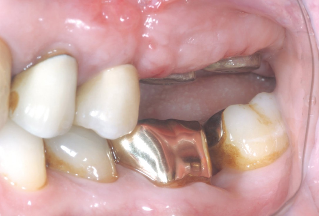 Intraoperative view after fixation of maxgraft® cortico with a micro screw system- Placement in parallel technique to obtain a horizontal and vertical augmentation