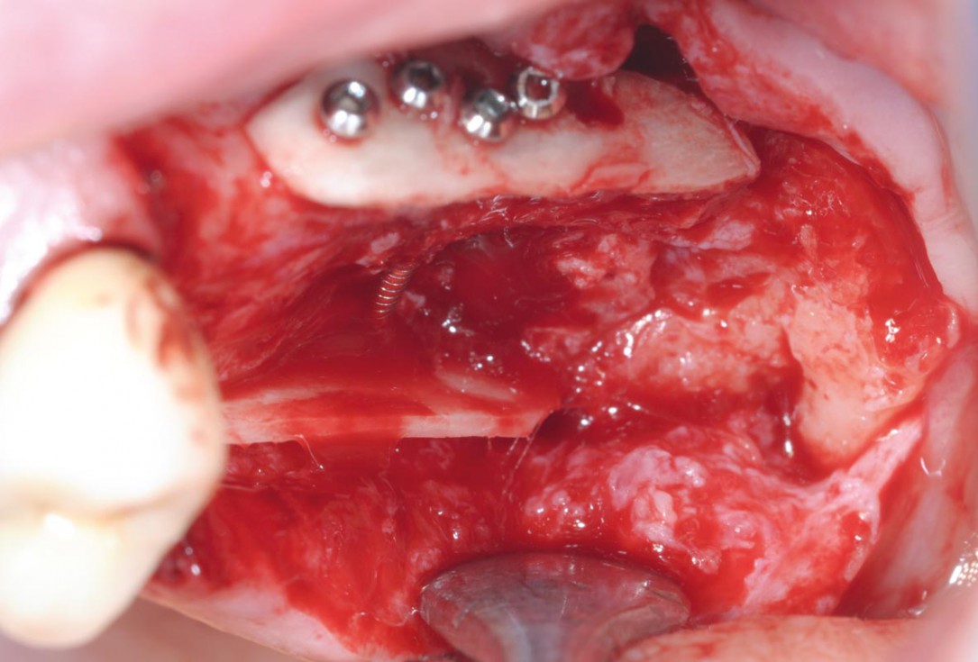 Treatment of a combined horizontal and vertical bone defect in the maxilla with maxgraft® cortico in the allogenic shell technique - Dr. R. Würdinger