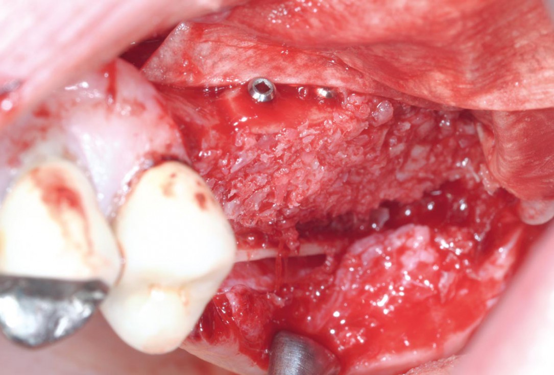 Intraoperative view after fixation of maxgraft® cortico with a micro screw system- Placement in parallel technique to obtain a horizontal and vertical augmentation