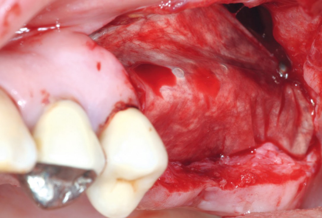 Intraoperative view after fixation of maxgraft® cortico with a micro screw system- Placement in parallel technique to obtain a horizontal and vertical augmentation