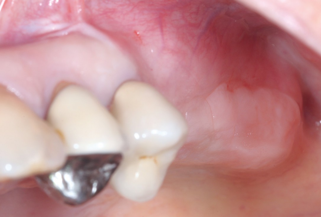Intraoperative view after fixation of maxgraft® cortico with a micro screw system- Placement in parallel technique to obtain a horizontal and vertical augmentation