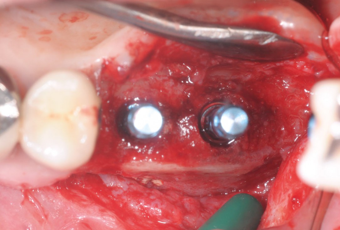 Intraoperative view after fixation of maxgraft® cortico with a micro screw system- Placement in parallel technique to obtain a horizontal and vertical augmentation
