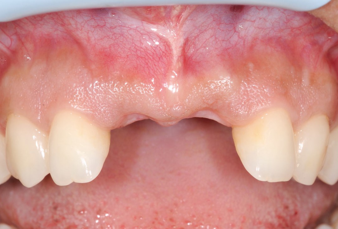 Bone augmentation in aesthetic zone with maxgraft® bonering - Dr. A. Patel