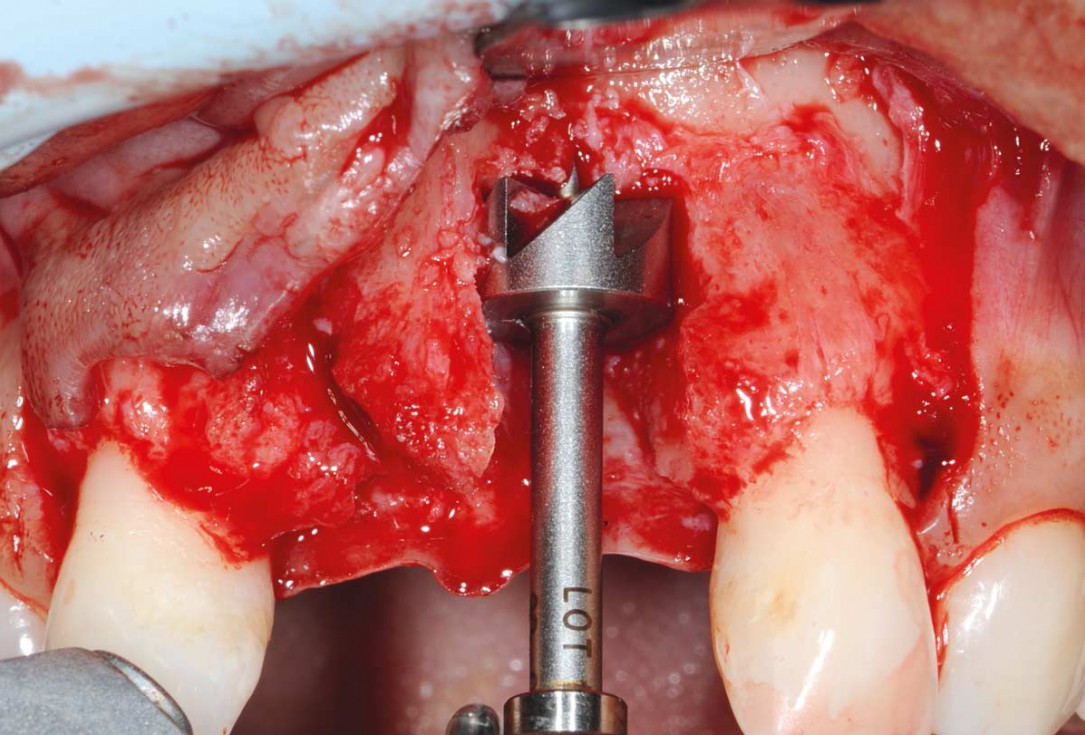 Bone augmentation in aesthetic zone with maxgraft® bonering - Dr. A. Patel