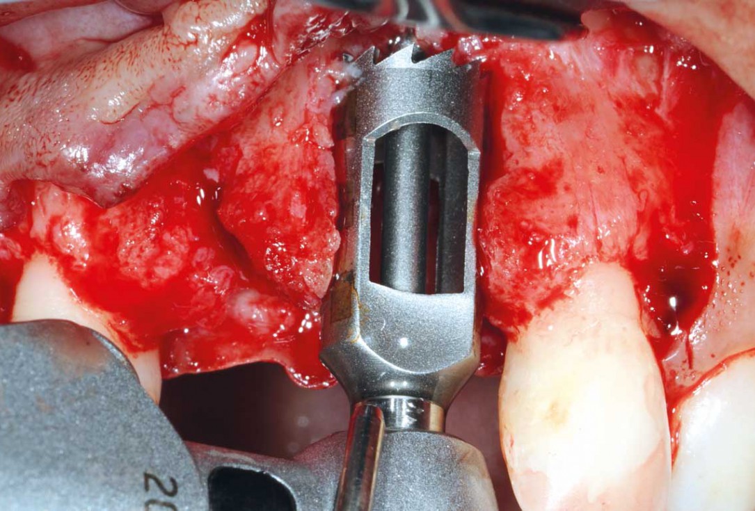 Bone augmentation in aesthetic zone with maxgraft® bonering - Dr. A. Patel