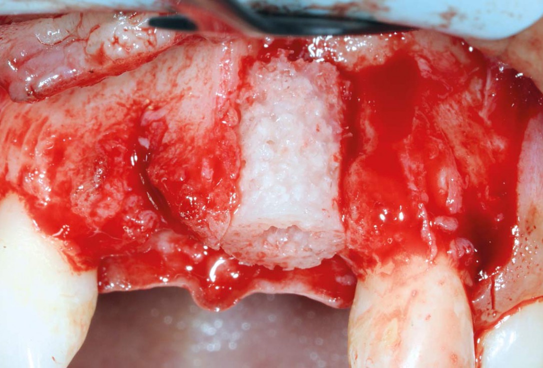 Bone augmentation in aesthetic zone with maxgraft® bonering - Dr. A. Patel