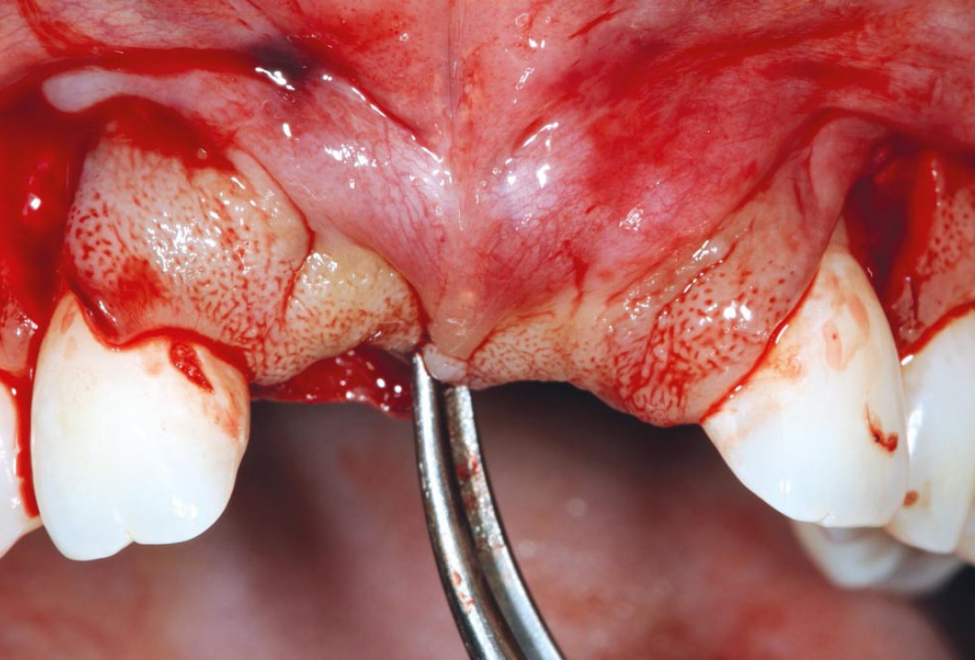 Bone augmentation in aesthetic zone with maxgraft® bonering - Dr. A. Patel