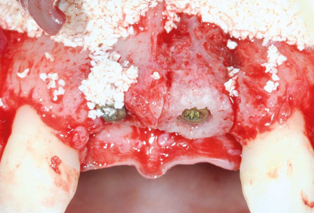 Bone augmentation in aesthetic zone with maxgraft® bonering - Dr. A. Patel