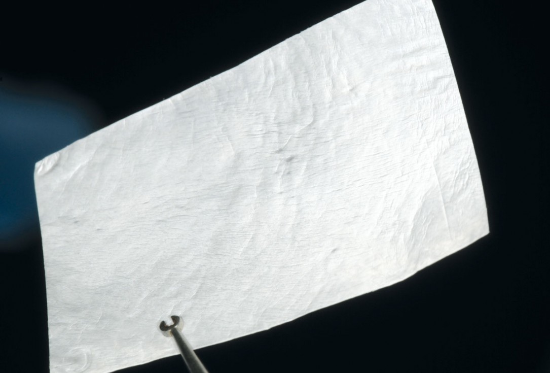 Bone augmentation in aesthetic zone with maxgraft® bonering - Dr. A. Patel