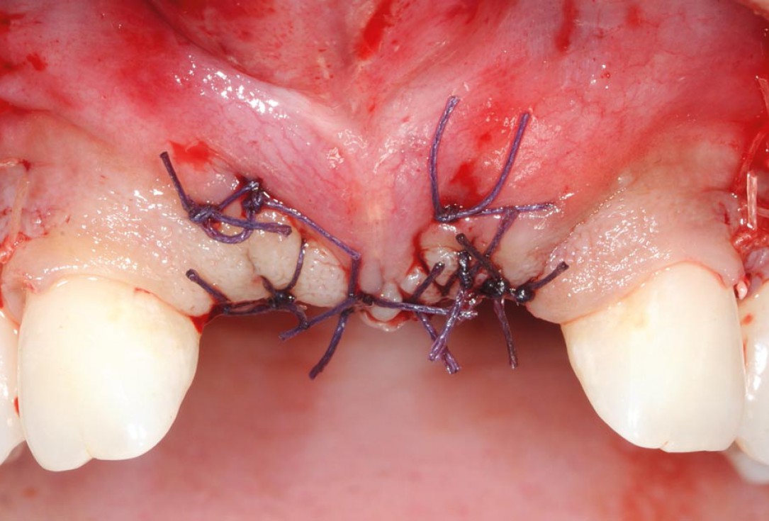 Bone augmentation in aesthetic zone with maxgraft® bonering - Dr. A. Patel