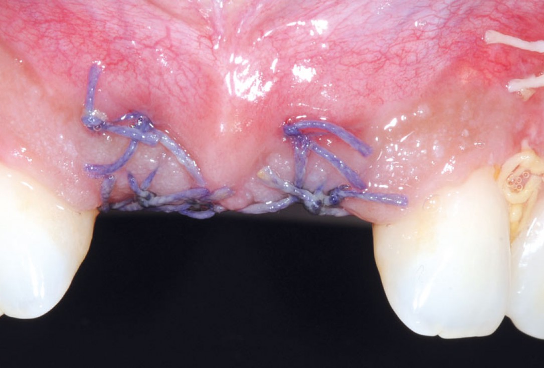 Bone augmentation in aesthetic zone with maxgraft® bonering - Dr. A. Patel