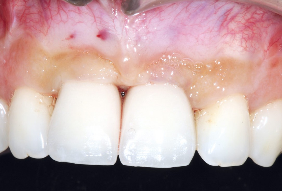 Bone augmentation in aesthetic zone with maxgraft® bonering - Dr. A. Patel