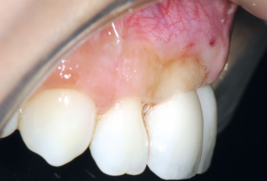 Bone augmentation in aesthetic zone with maxgraft® bonering - Dr. A. Patel