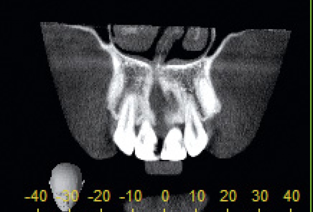 Bone augmentation in aesthetic zone with maxgraft® bonering - Dr. A. Patel