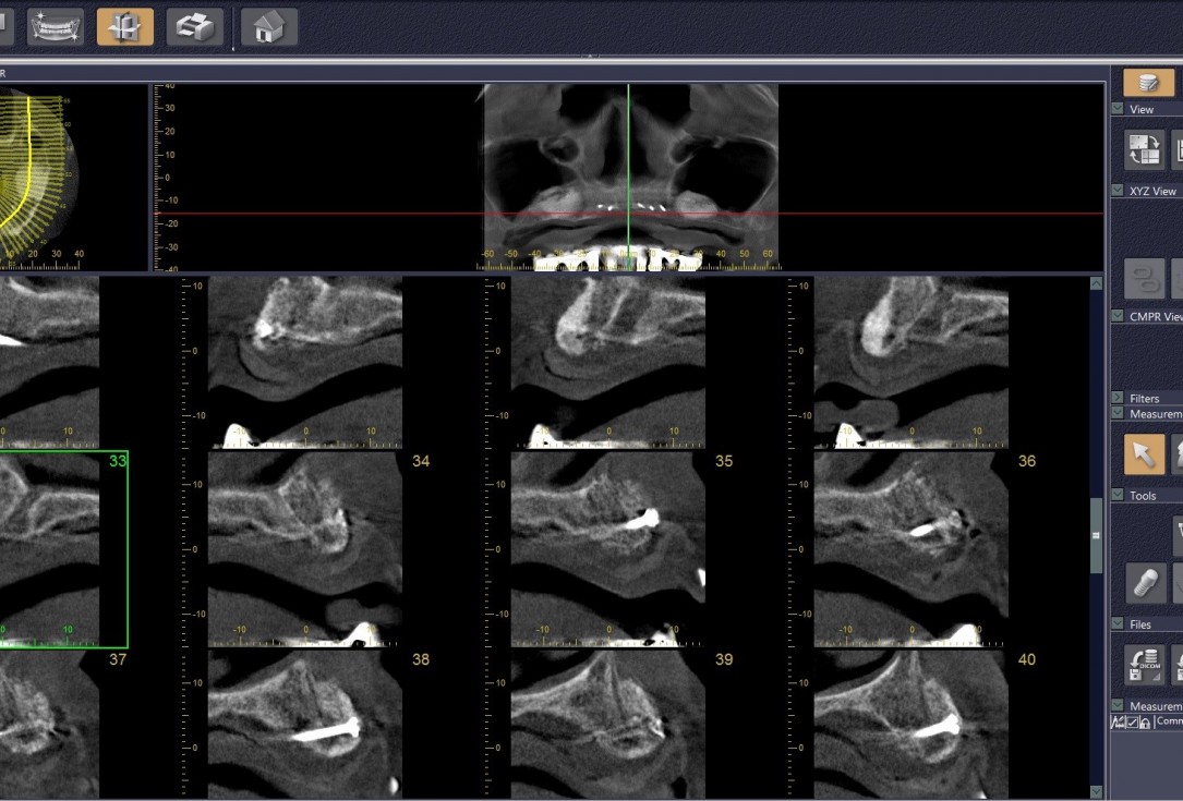 Reconstruction of maxillary ridge with maxgraft® block - Amit Patel