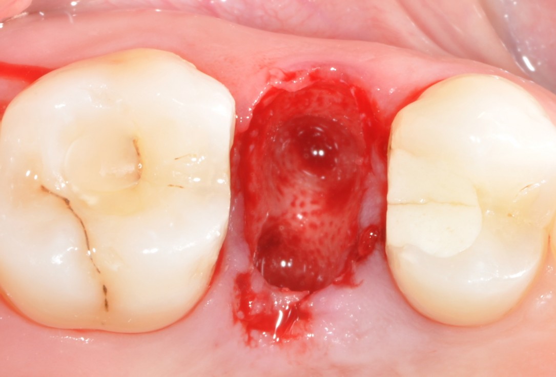 Application of collacone® to extraction socket