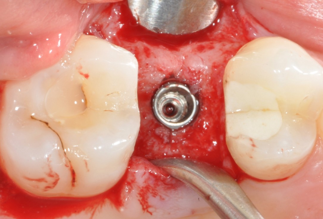 Application of collacone® to extraction socket