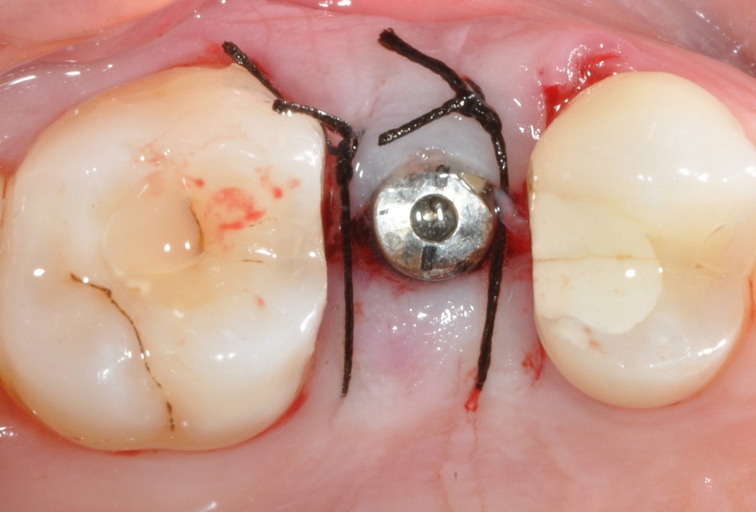 Application of collacone® to extraction socket