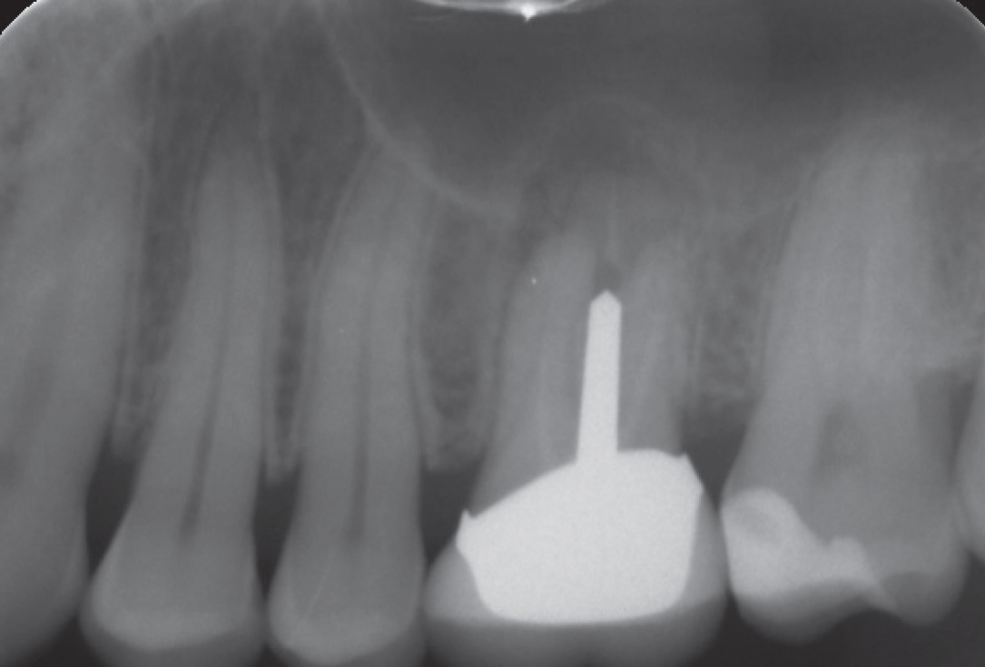 Internal Sinus lift - Dr. Frank Kistler