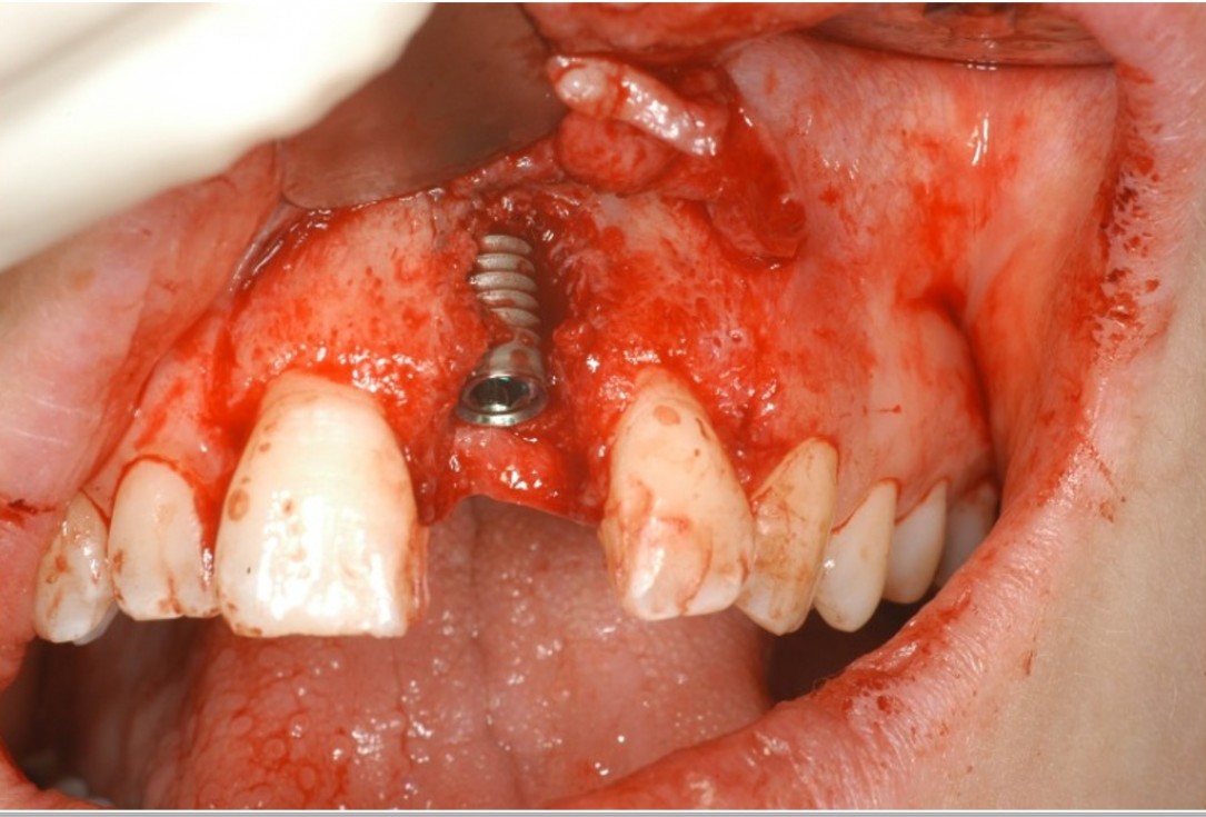 botiss cerabone® & Jason® membrane for treatment of dehiscence defect - Clinical case by Dr. M. Steigmann