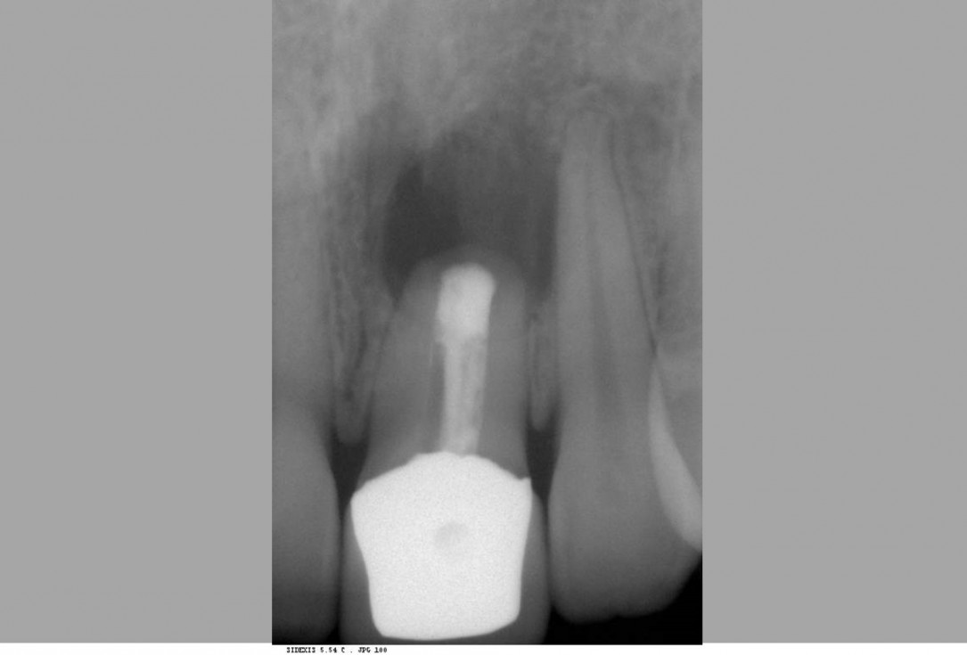 botiss cerabone® & Jason® membrane for treatment of dehiscence defect - Clinical case by Dr. M. Steigmann