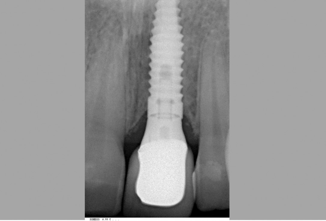 botiss cerabone® & Jason® membrane for treatment of dehiscence defect - Clinical case by Dr. M. Steigmann