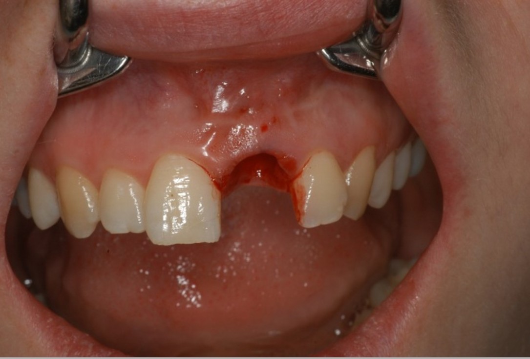 botiss cerabone® & Jason® membrane for treatment of dehiscence defect - Clinical case by Dr. M. Steigmann