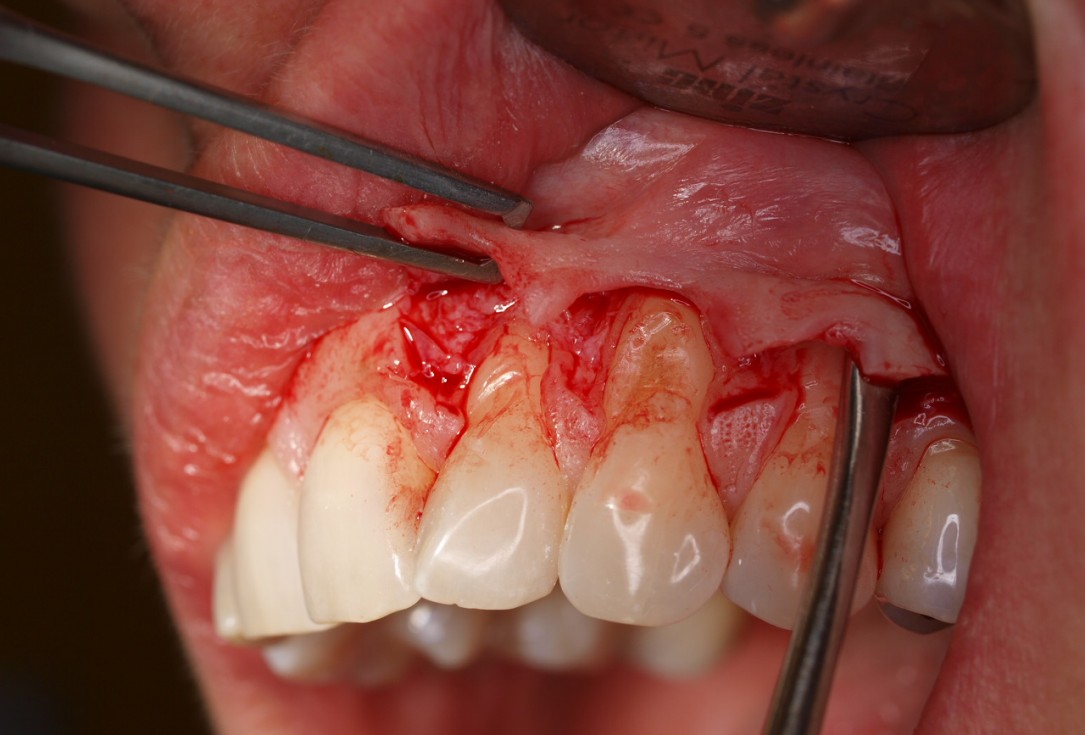 Multiple gingival recessions treated by MCAF in conjunction with mucoderm® - Hägewald