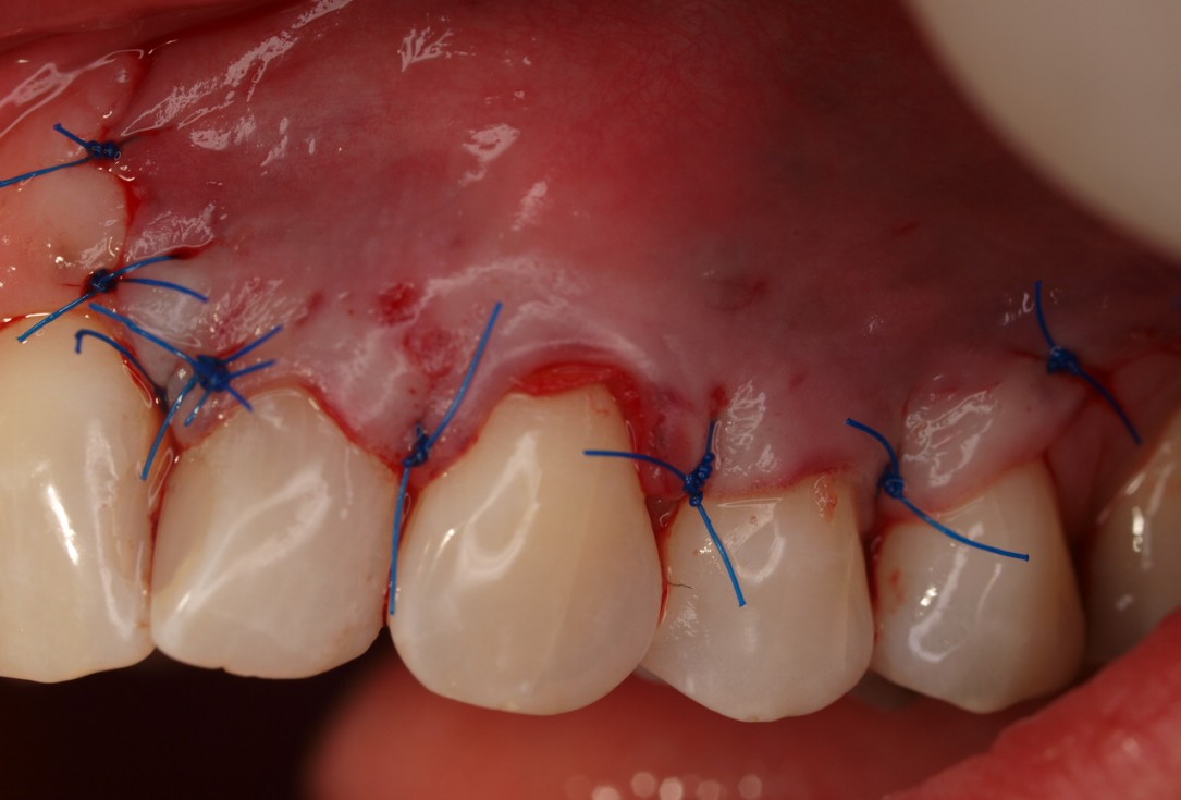 Multiple gingival recessions treated by MCAF in conjunction with mucoderm® - Hägewald