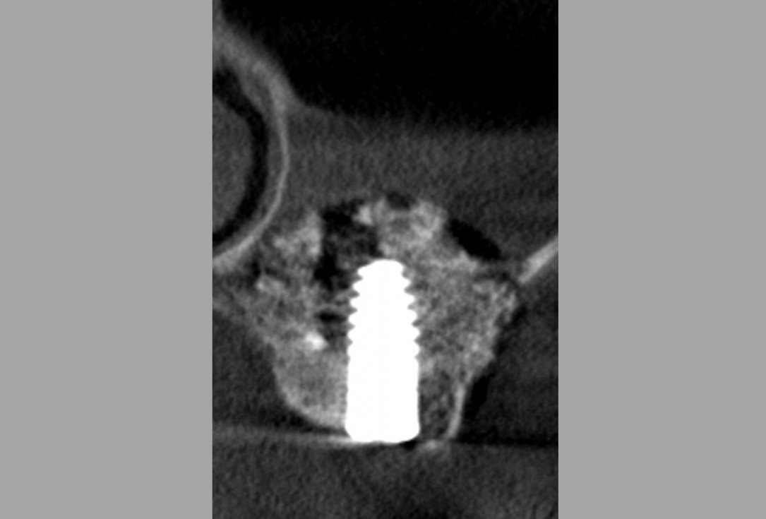 Sinus lift one-stage with cerabone® and collprotect® membrane - Dr. V. Kalenchuk