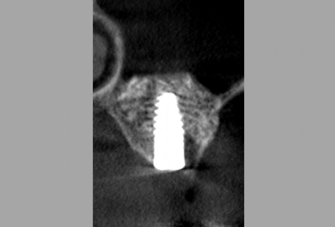 Sinus lift one-stage with cerabone® and collprotect® membrane - Dr. V. Kalenchuk