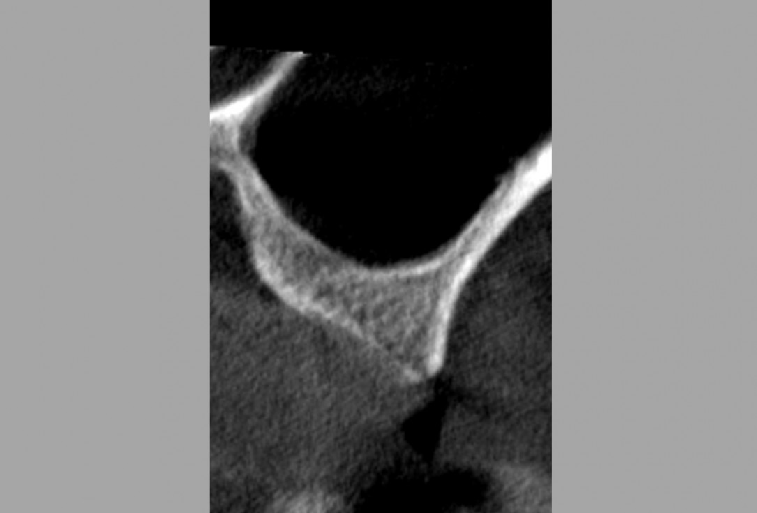 Sinus lift one-stage with cerabone® and collprotect® membrane - Dr. V. Kalenchuk