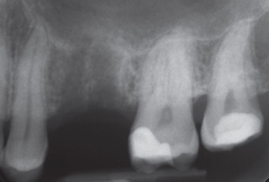 Internal Sinus lift - Dr. Frank Kistler