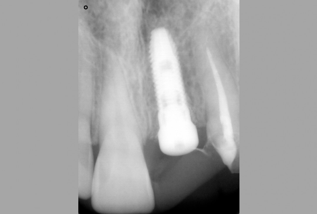 Socket preservation with cerabone® - Dr. Rahib Adi Nader